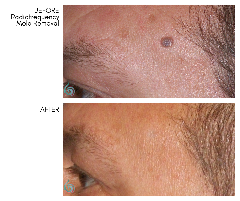 List 102 Pictures Mole Removal Before And After Pictures Updated