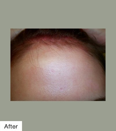 After Mole Removal