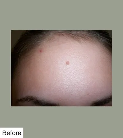 Before Mole Removal