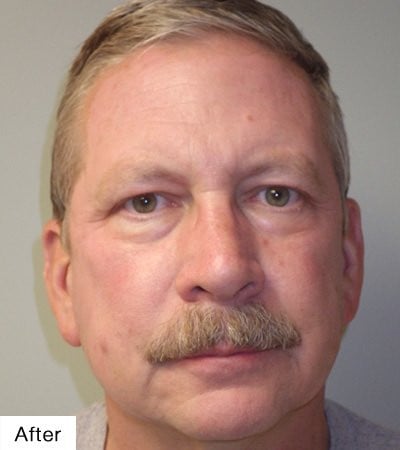 after facial resurfacing