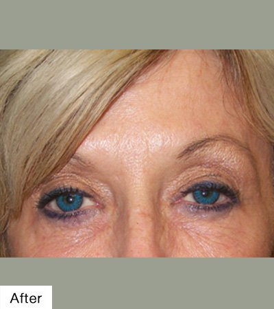Botox After