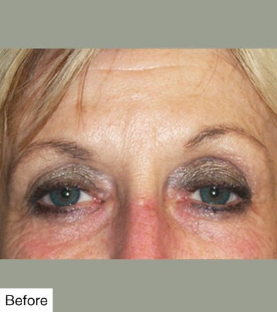 Botox Before
