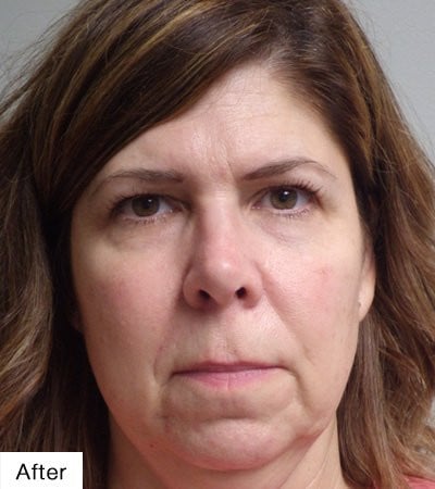 after facial resurfacing