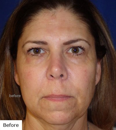 before facial resurfacing