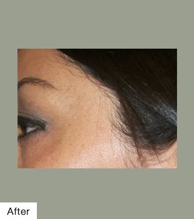 after Mole Removal