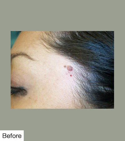 before Mole Removal