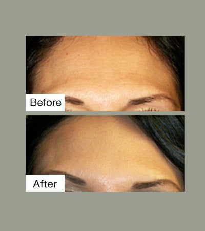 Botox Before & After