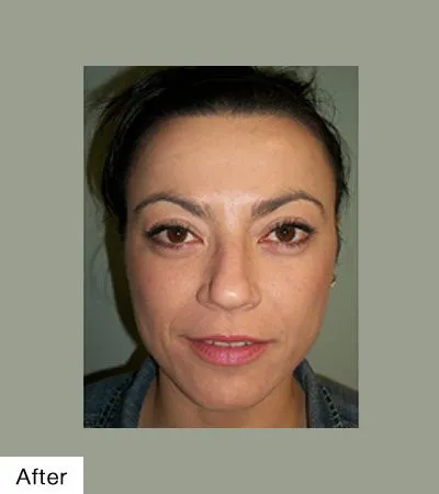 Botox After