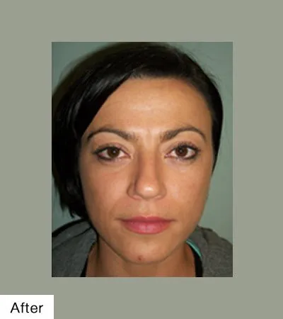 Botox Before