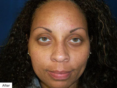 after Permanent Makeup