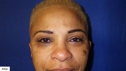 after Permanent Makeup