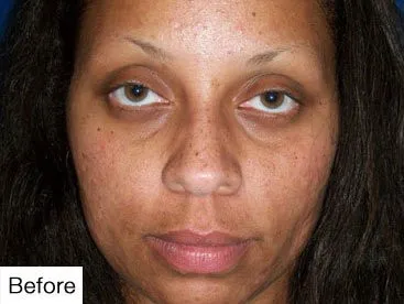 before Permanent Makeup