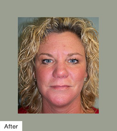 Botox After
