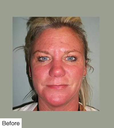 Botox Before