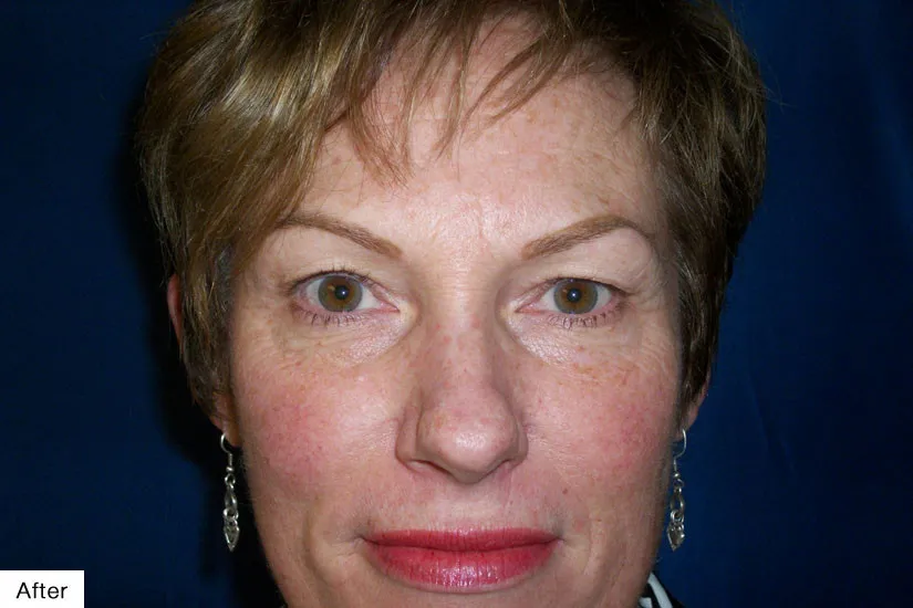 after Permanent Makeup