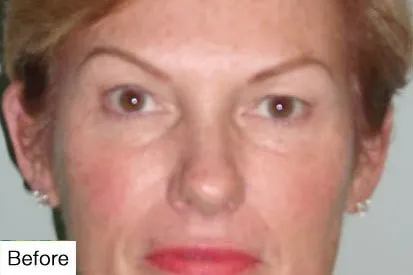 Before Permanent Makeup