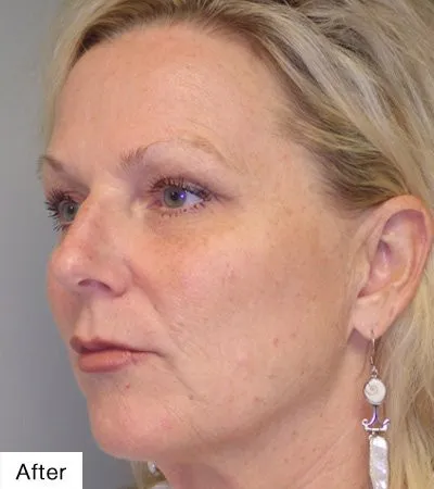 after facial resurfacing