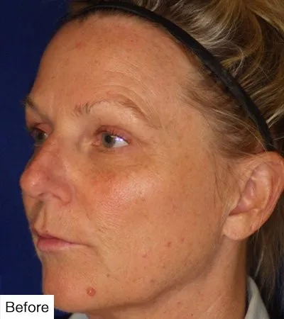 before facial resurfacing