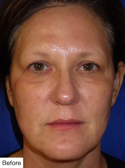 Filler Before