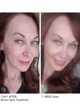 Age Spot Removal