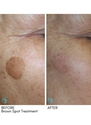 Age Spot Removal