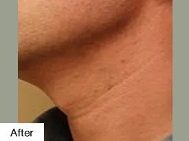after Laser Hair Removal