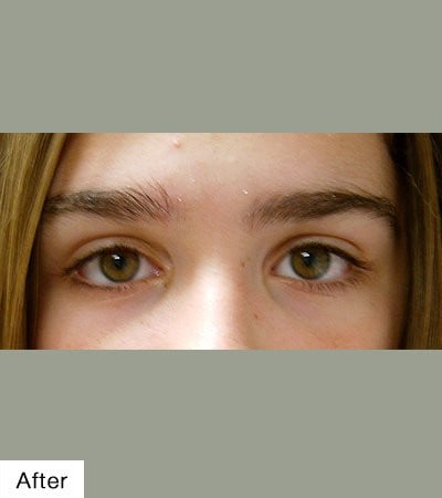 after Laser Hair Removal
