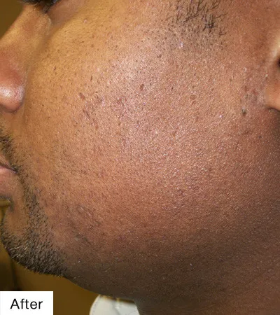 after Laser Hair Removal