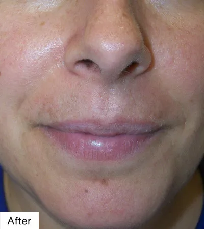 After Laser Hair Removal