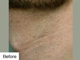 before Laser Hair Removal