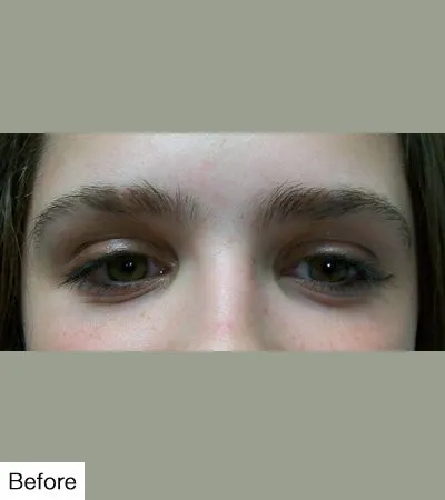 before Laser Hair Removal