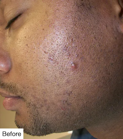 before Laser Hair Removal