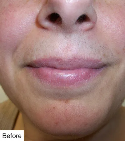 Before Laser Hair Removal