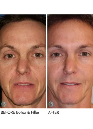 Injectables & Filler Before & After