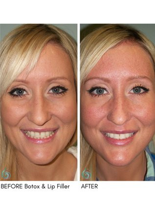 Injectables & Filler Before & After