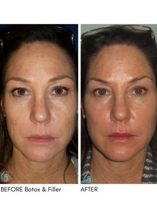 Injectables & Filler Before & After