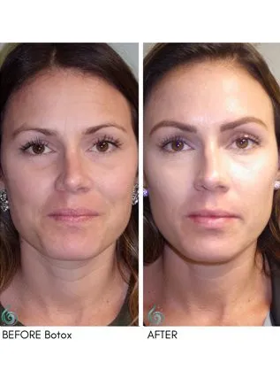 Injectables & Filler Before & After