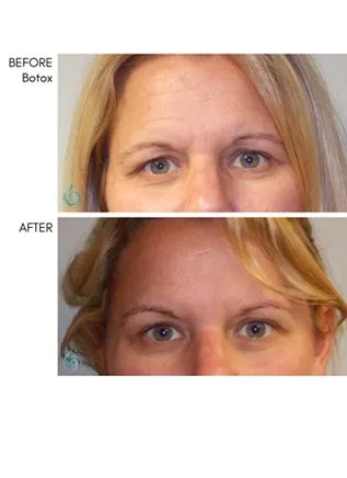 Injectables & Filler Before & After