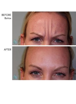 Injectables & Filler Before & After