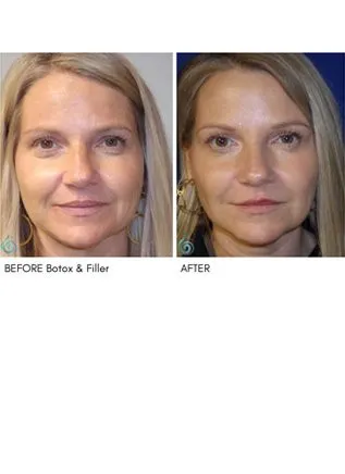 Injectables & Filler Before & After