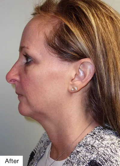 After Kybella