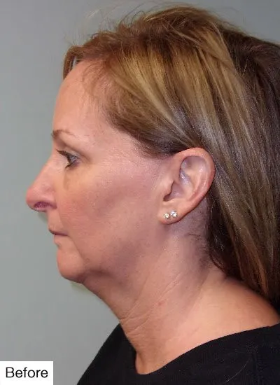 Before Kybella