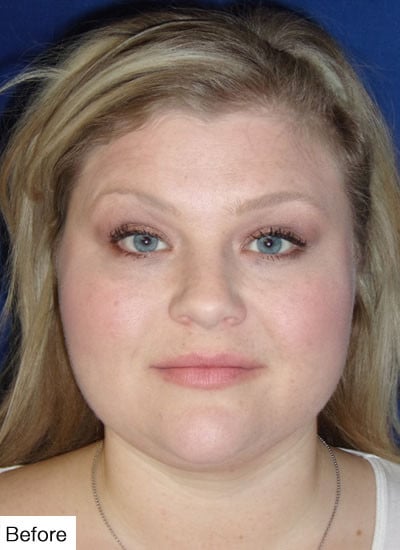 Before Kybella