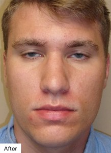 After Laser Acne Treatment