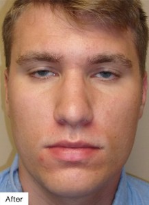 After Laser Acne Treatment