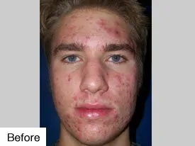 Before Laser Acne Treatment