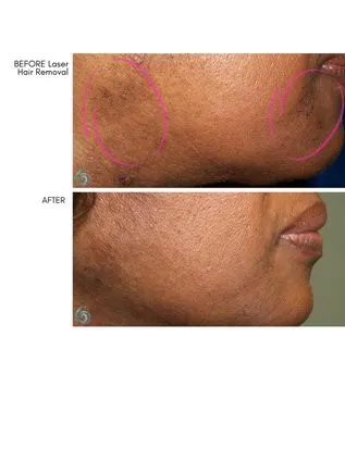 Laser Hair Removal