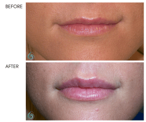 Before & After Lip Sculpting