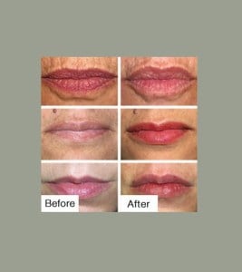 Before & After Lip Sculpting