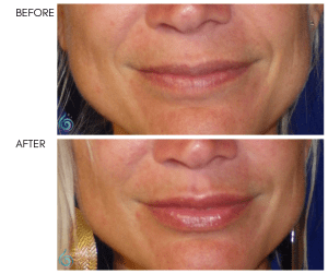 Before & After Lip Sculpting